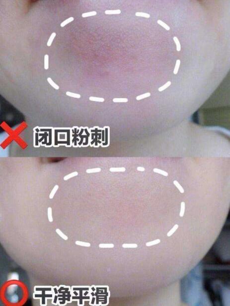 闭口粉刺是怎么形成的原因