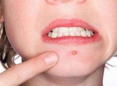 嘴巴周围长痘痘的原因是什么